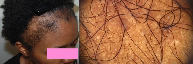 Traction alopecia