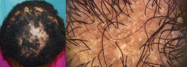Central Centrifugal Cicatricial Alopecia