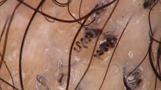 Corckscrew hair in black haired tinea capitis