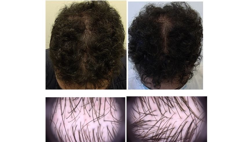 Alopecia