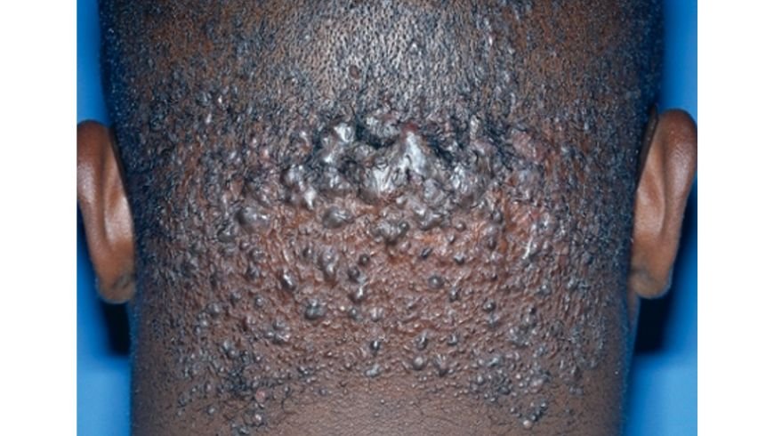 Dandruff