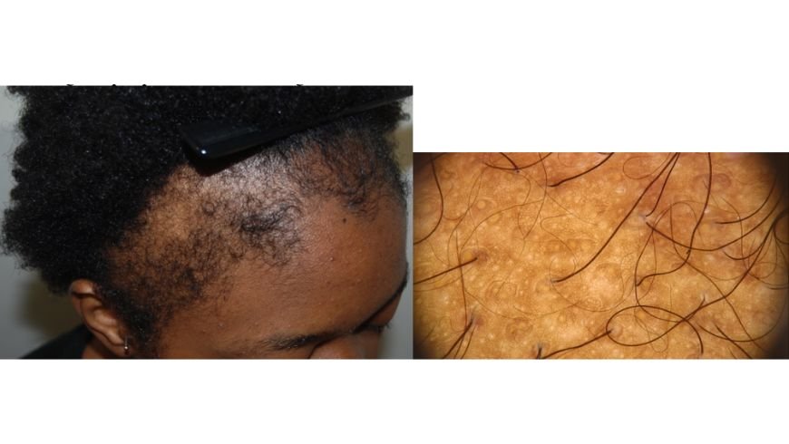 Scalp disorders